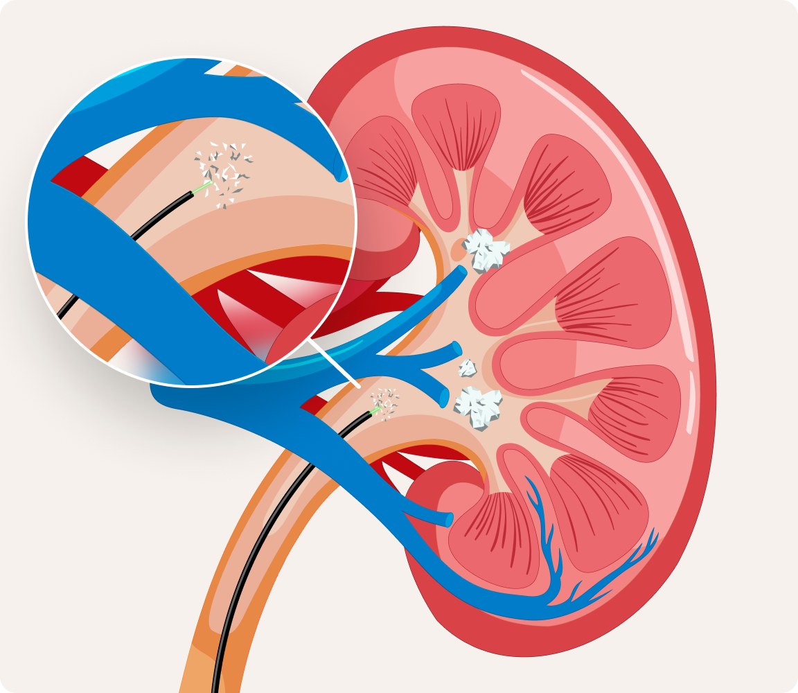 A diagram of a kidney showing how the CVAC System accesses kidney stones